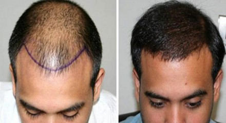 استعد شبابك: كل ما تريد معرفته عن زراعة الشعر في العاصمة