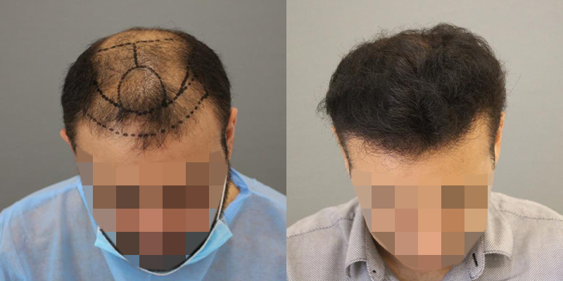 Advancements in Robotic Hair Transplant in Riyadh: 2026 Edition