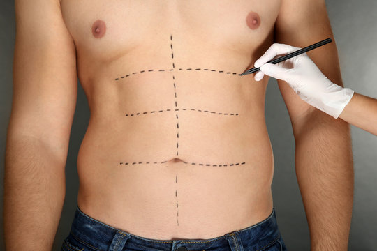 Liposuction Riyadh for Men: Achieving the Chiseled V-Taper